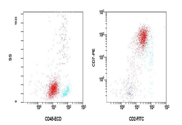 Flow cytometry of bone marrow showing a prominent T-lymphoblast population (second admission)
